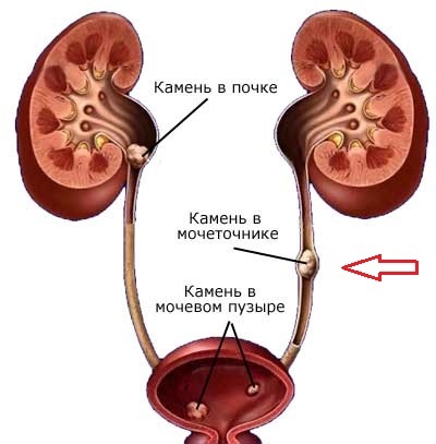 камни в почках